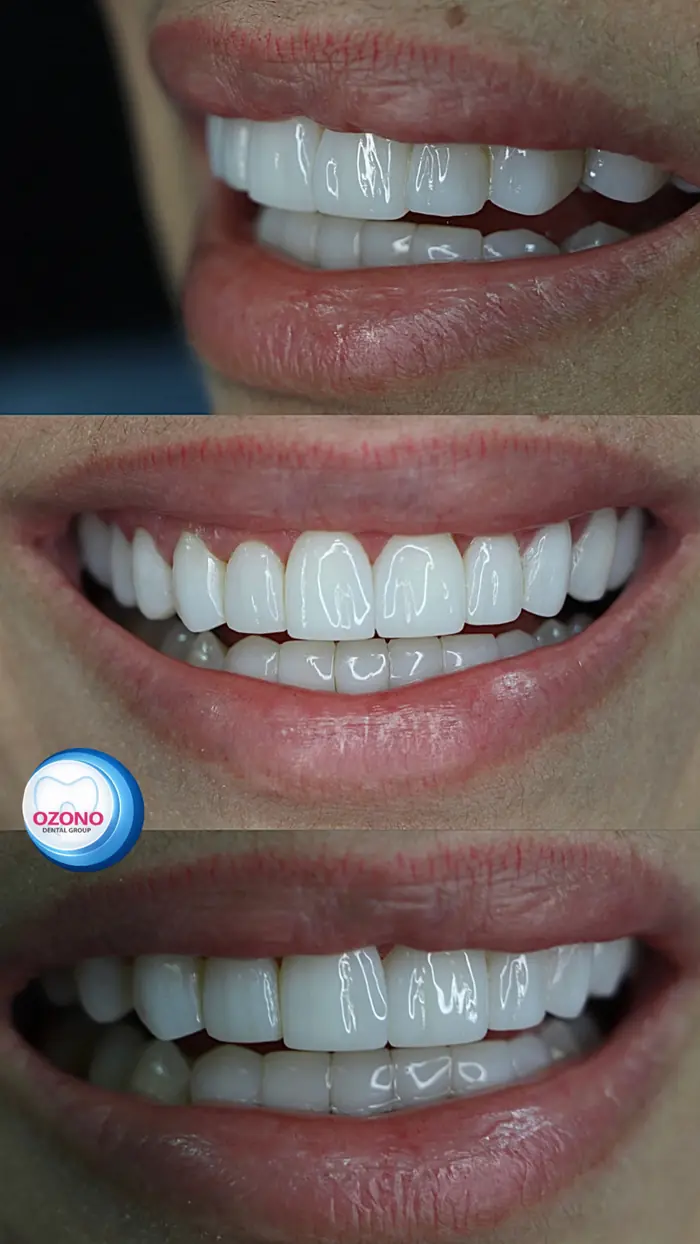 Caso real: Diseño de sonrisa · resultado en Ozono Dental Group