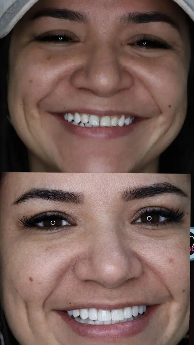 Caso real: Estética dental · antes y después en Ozono Dental Group