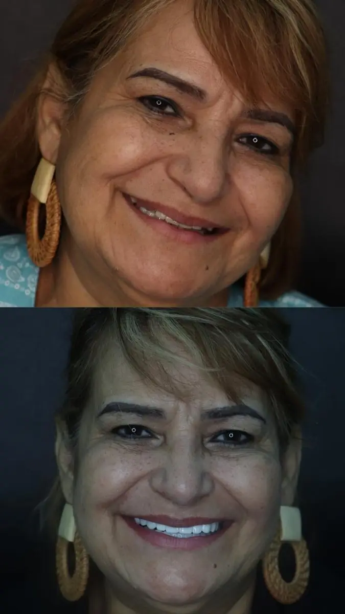 Caso real: Estética dental · retrato en Ozono Dental Group
