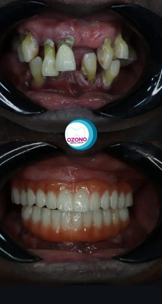 Caso real: Rehabilitación oral · vista intraoral en Ozono Dental Group