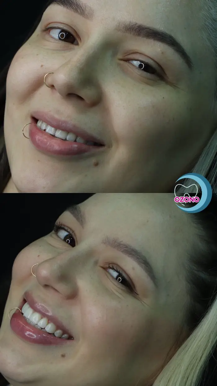 Caso real: Estética dental · antes y después en Ozono Dental Group