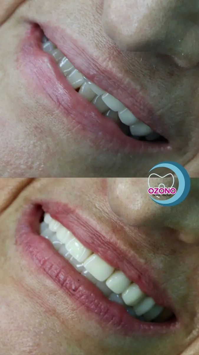 Caso real: Carillas · sonrisa lateral en Ozono Dental Group