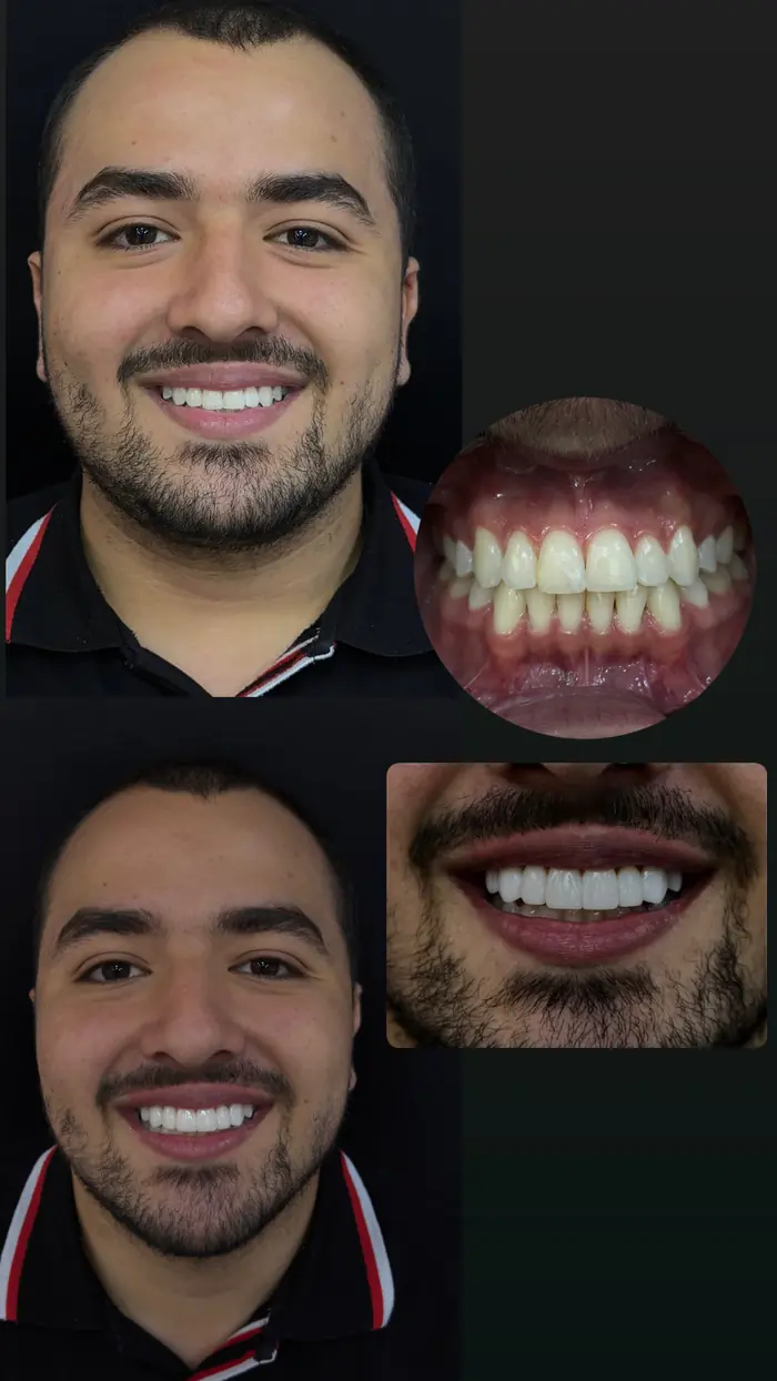 Caso real: Diseño de sonrisa · caso completo en Ozono Dental Group