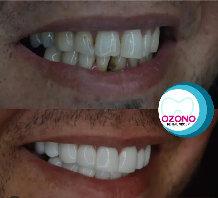 Caso real: Carillas · cambio total en Ozono Dental Group