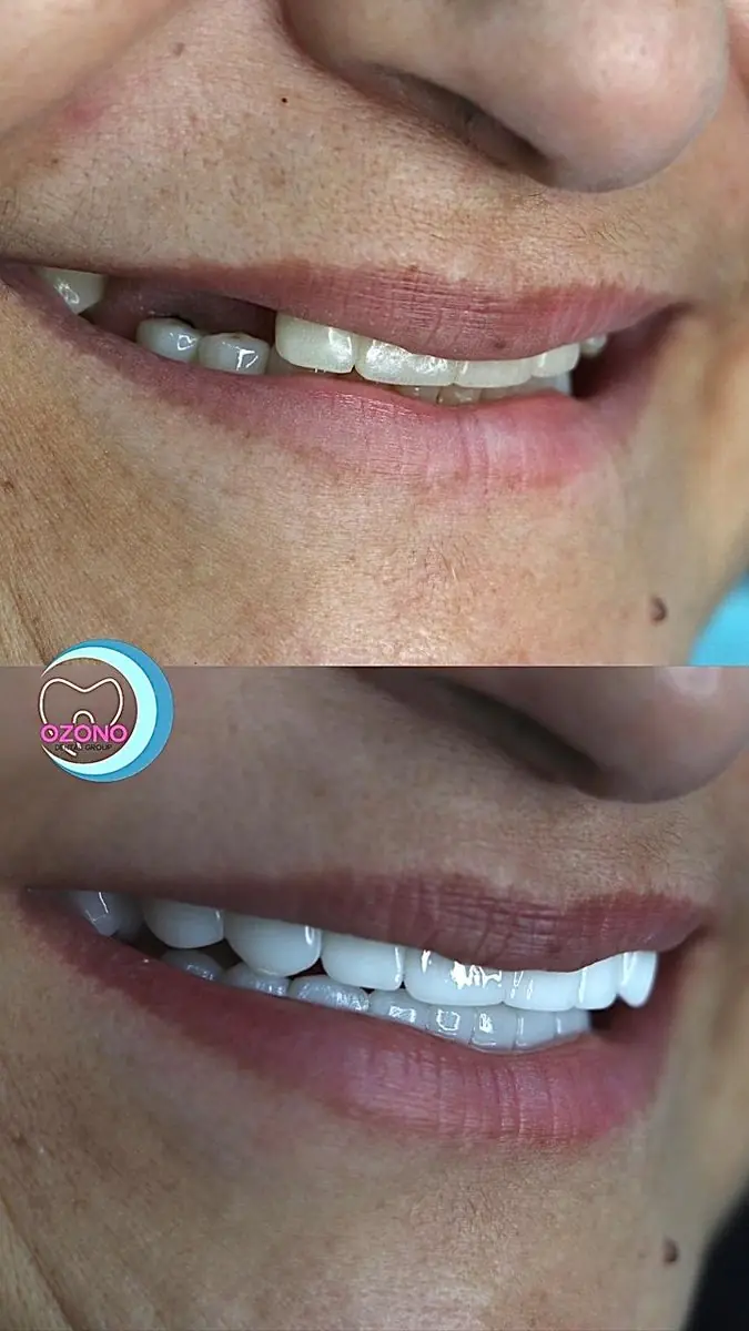 Caso real: Carillas · perfil en Ozono Dental Group