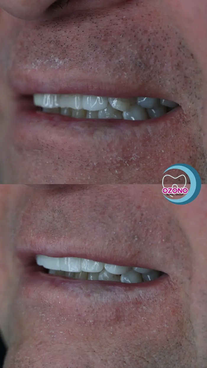 Caso real: Carillas · cambio total en Ozono Dental Group