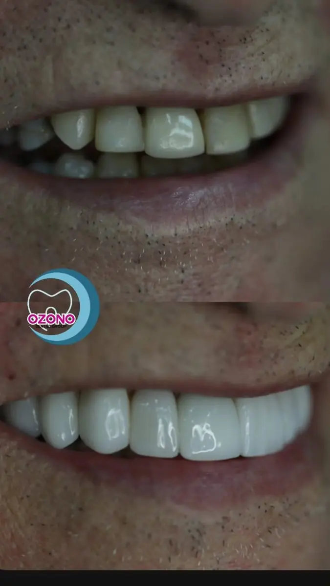 Caso real: Carillas · sonrisa renovada en Ozono Dental Group
