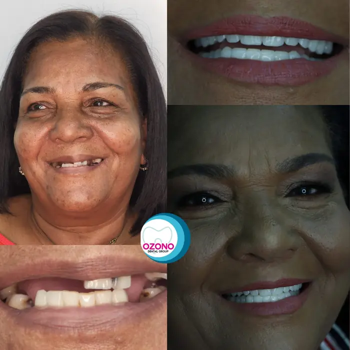 Caso real: Diseño de sonrisa · caso completo en Ozono Dental Group