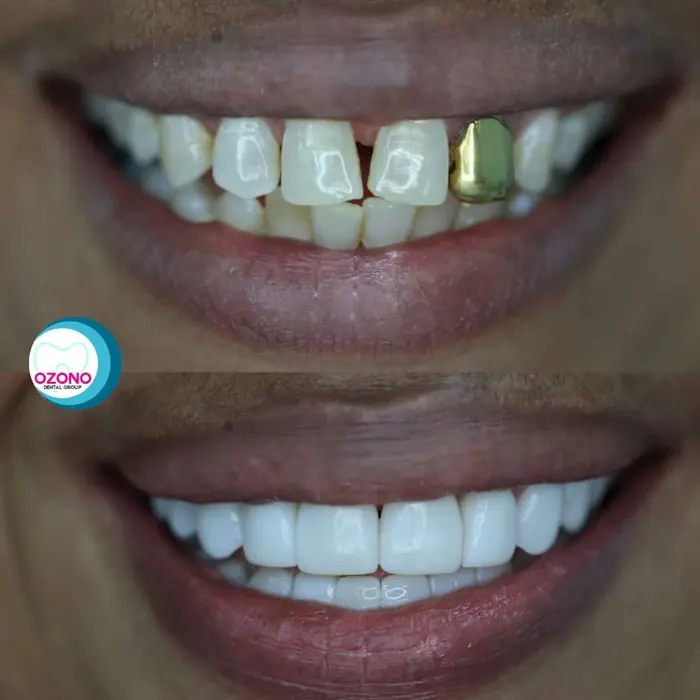 Caso real: Carillas · transformación completa en Ozono Dental Group
