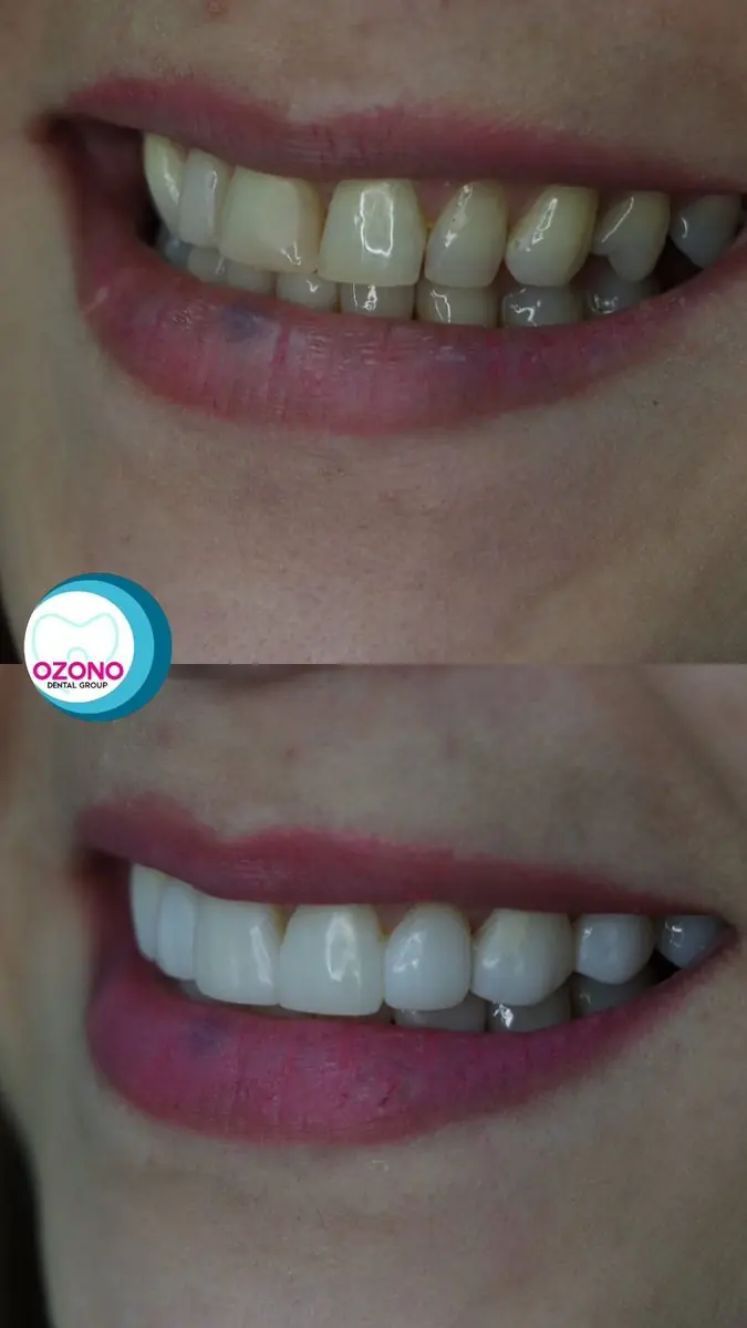 Caso real: Rehabilitación oral · perfil en Ozono Dental Group