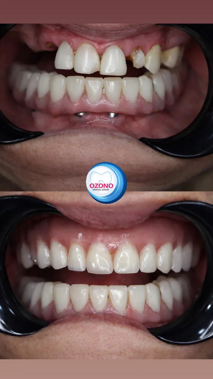 Caso real: Rehabilitación con implantes · antes y después en Ozono Dental Group
