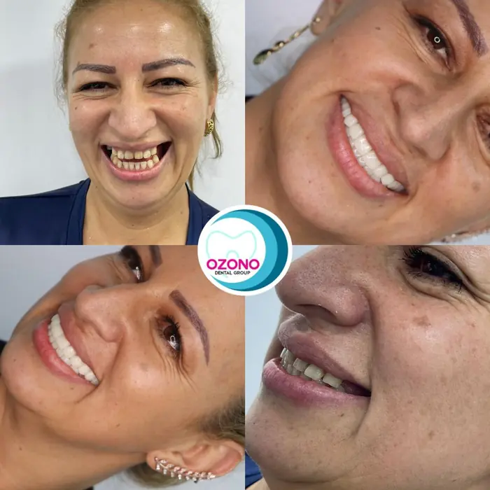 Caso real: Estética dental · collage en Ozono Dental Group