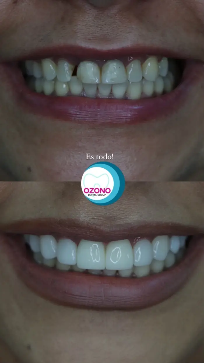 Caso real: Carillas · nueva sonrisa en Ozono Dental Group