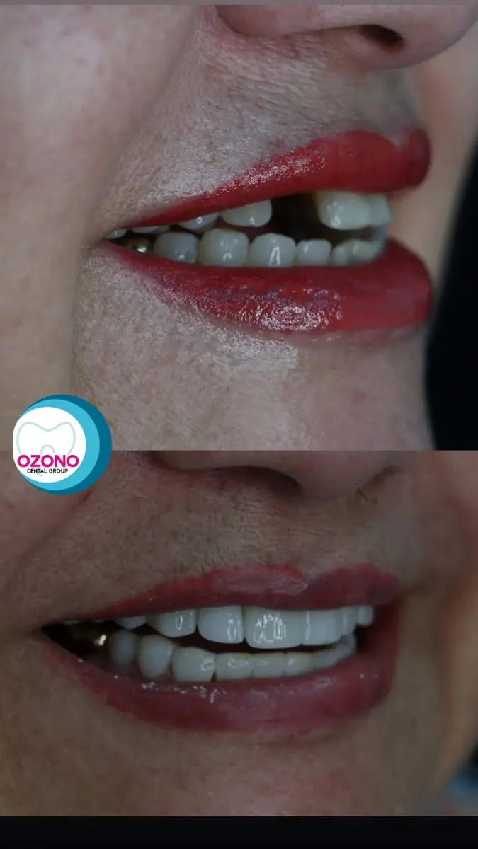 Caso real: Rehabilitación oral · antes y después en Ozono Dental Group