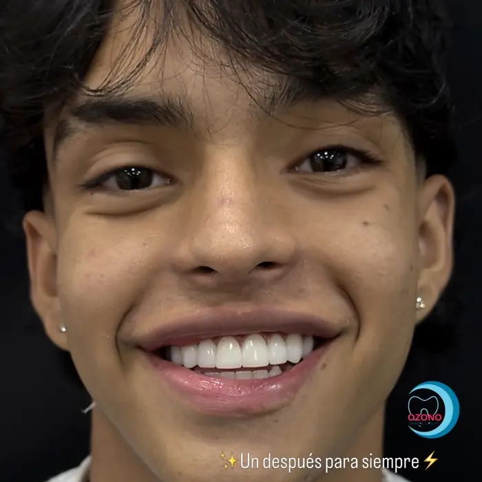 Caso real: Estética dental · después en Ozono Dental Group
