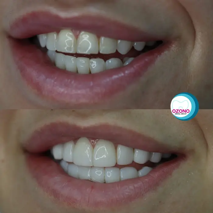 Caso real: Carillas · primer plano en Ozono Dental Group