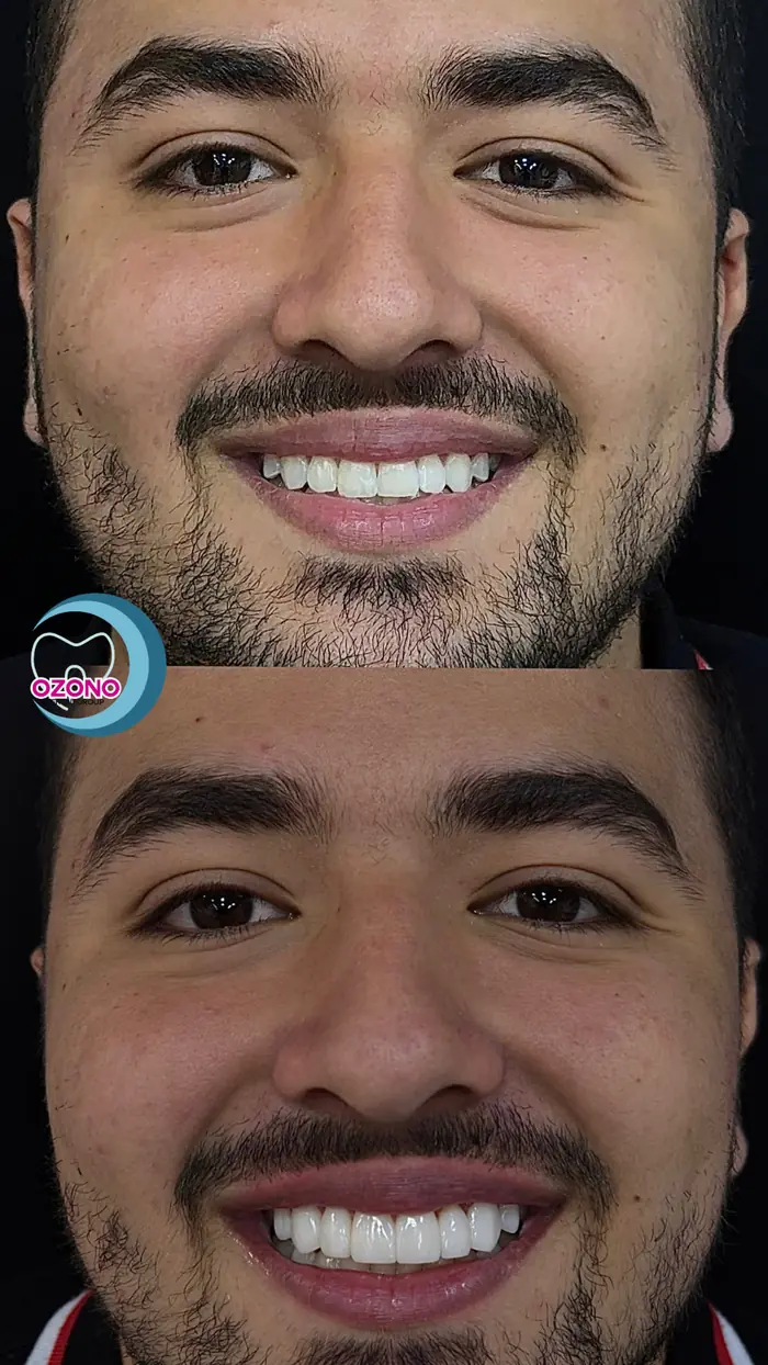 Caso real: Diseño de sonrisa · antes y después en Ozono Dental Group