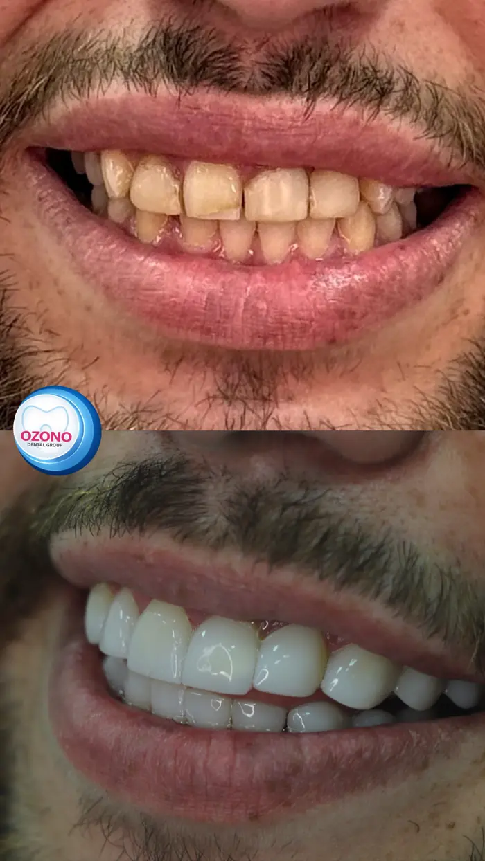 Caso real: Carillas · antes y después en Ozono Dental Group