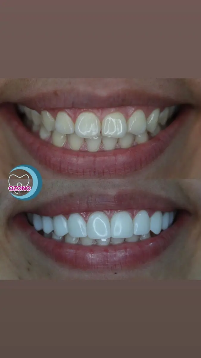 Caso real: Carillas · sonrisa frontal en Ozono Dental Group