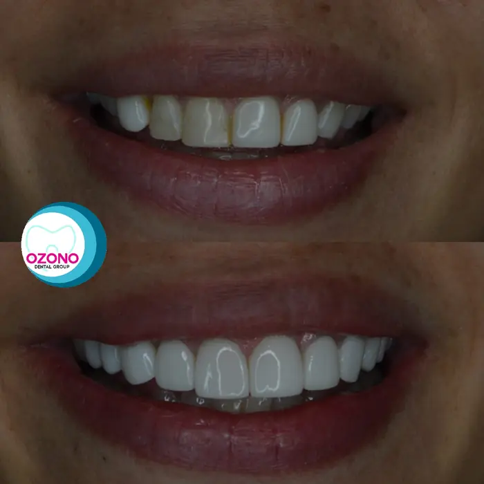 Caso real: Diseño de sonrisa · transformación en Ozono Dental Group