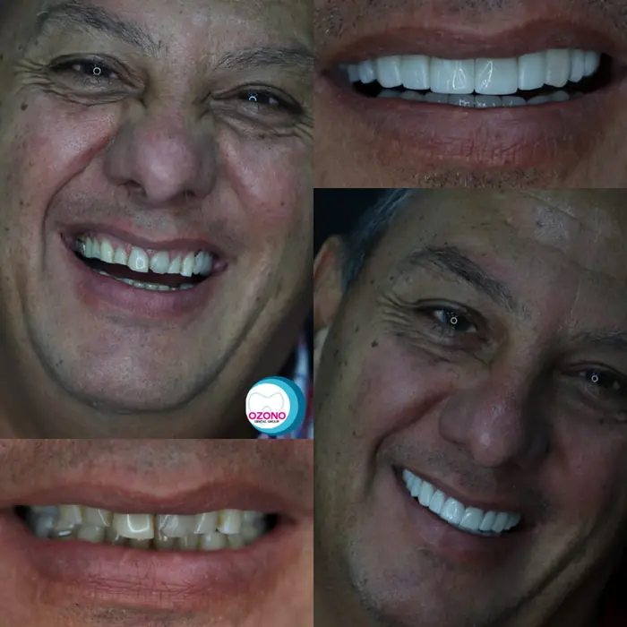 Caso real: Rehabilitación oral · caso completo en Ozono Dental Group
