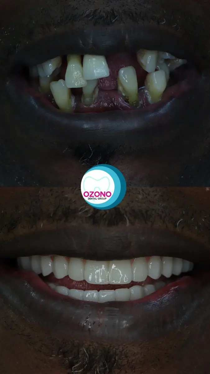 Caso real: Rehabilitación oral · cambio total en Ozono Dental Group