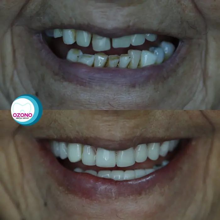 Caso real: Rehabilitación oral · antes y después en Ozono Dental Group