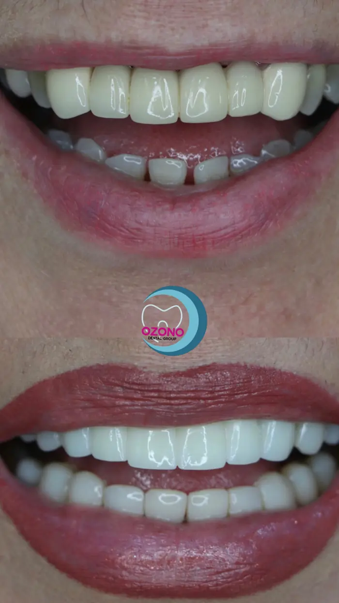 Caso real: Estética dental · transformación en Ozono Dental Group