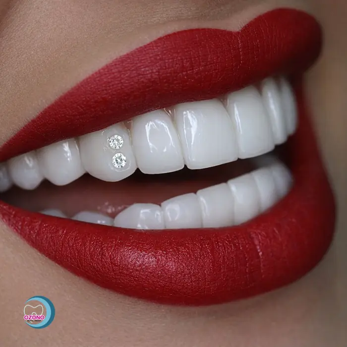 Caso real: Gemas dentales · brillo real en Ozono Dental Group