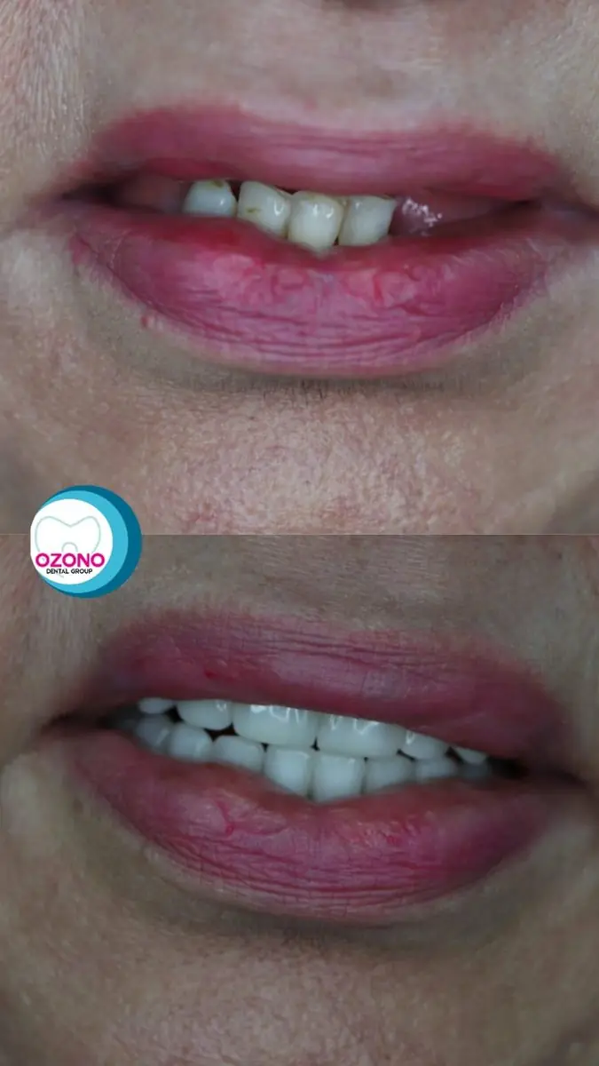 Caso real: Rehabilitación oral · frontal en Ozono Dental Group