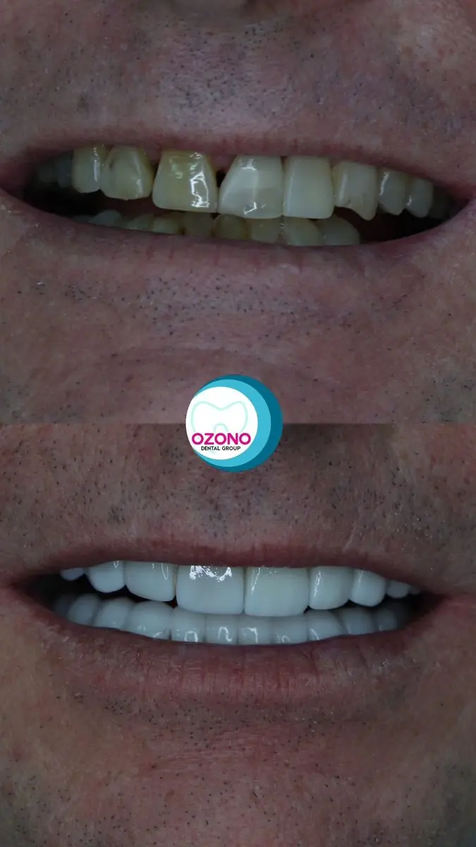 Caso real: Carillas · antes y después en Ozono Dental Group