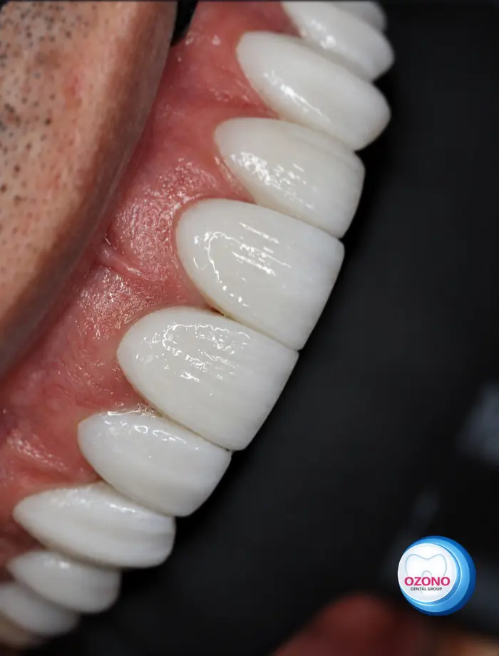 Caso real: Carillas · detalle del acabado en Ozono Dental Group