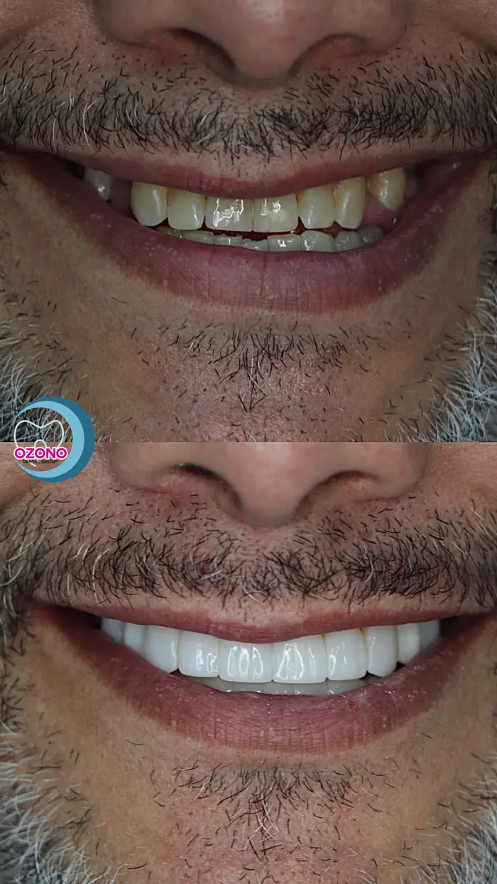 Caso real: Estética dental · cambio total en Ozono Dental Group
