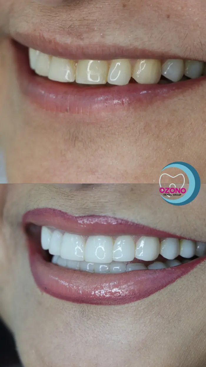 Caso real: Carillas · sonrisa renovada en Ozono Dental Group