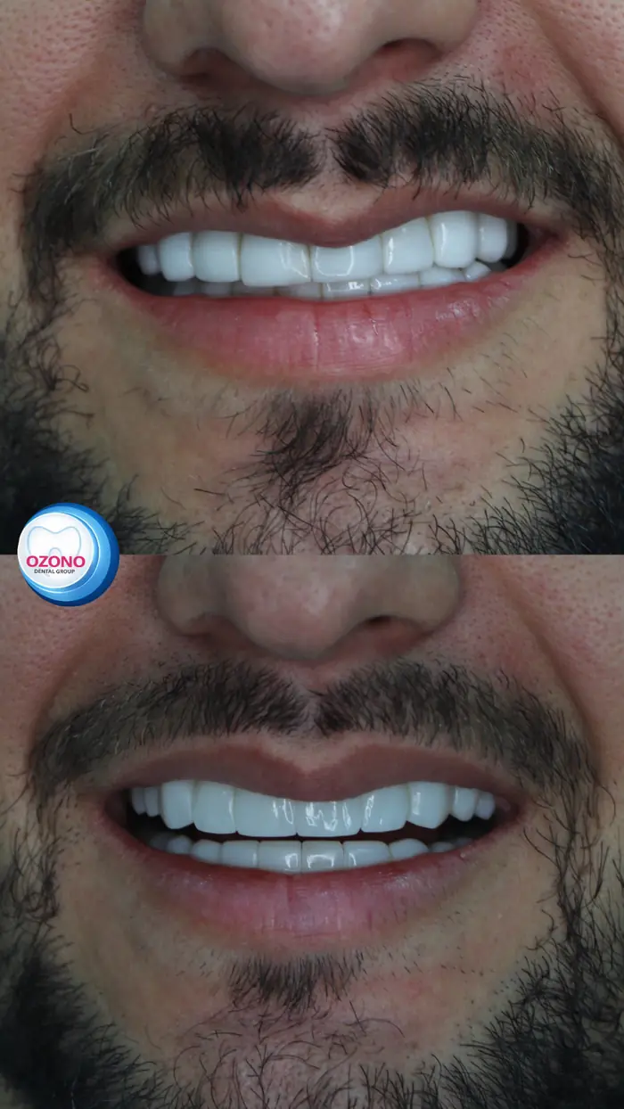Caso real: Diseño de sonrisa · antes y después en Ozono Dental Group