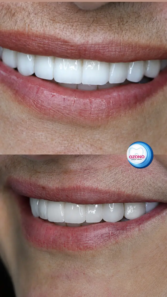 Caso real: Carillas · resultado final en Ozono Dental Group