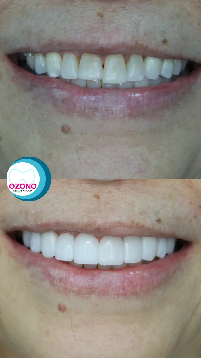 Caso real: Blanqueamiento · antes y después en Ozono Dental Group