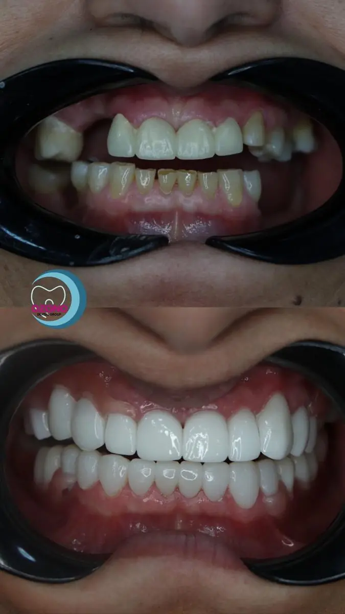 Caso real: Rehabilitación oral · vista intraoral en Ozono Dental Group