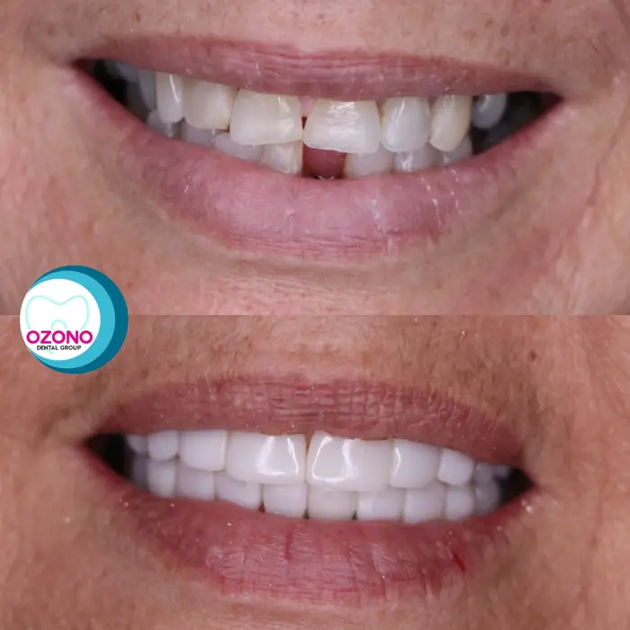 Caso real: Carillas · antes y después en Ozono Dental Group