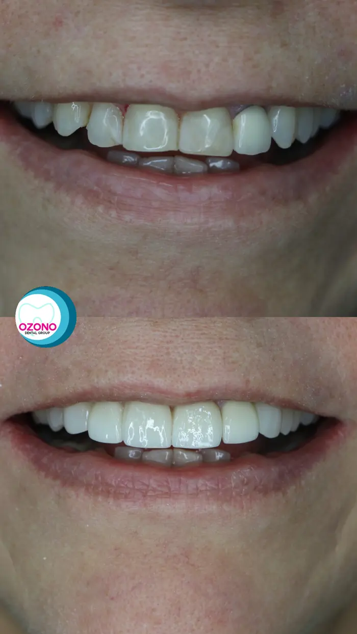 Caso real: Estética dental · antes y después en Ozono Dental Group