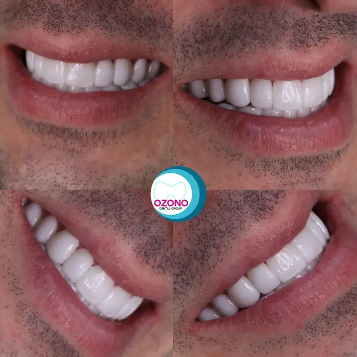 Caso real: Diseño de sonrisa · collage en Ozono Dental Group